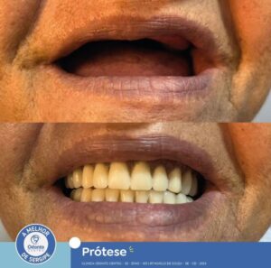 protese-dentaria-3